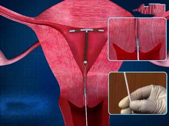 元宫cu365节育环，一位妇科医生跟你聊聊它的真实模样和使用体验